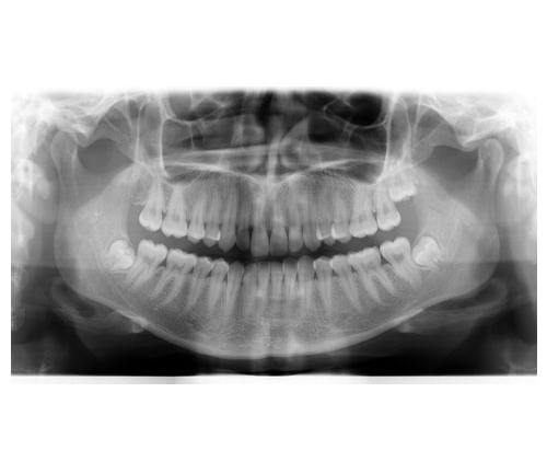 Panoramic x-ray image