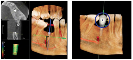 Implant and Restoration Plan with Gendex Cone Beam