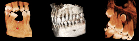Cone Beam in Endo, Root Investigations, Nerve Mapping