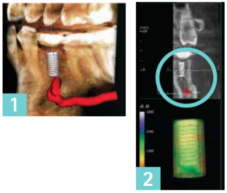 3D Implant Planning