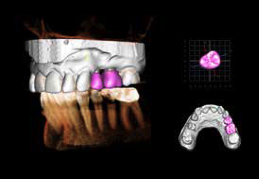 Invivo 5.3 Restoration Design